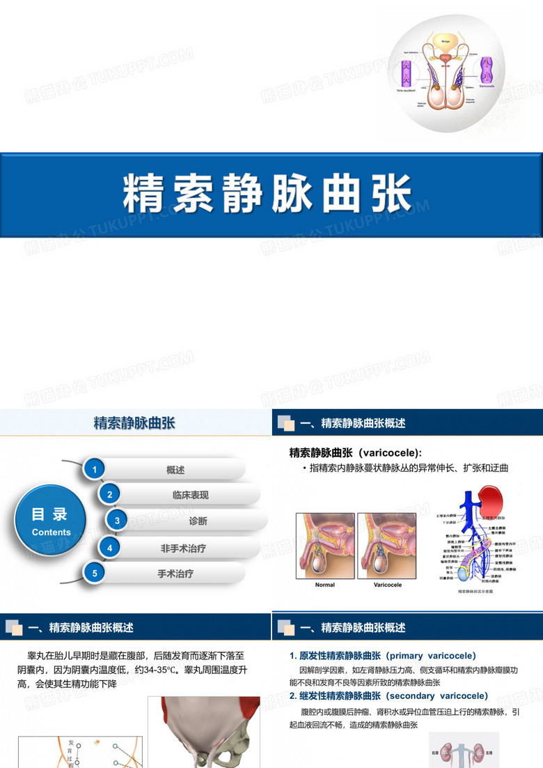 精索静脉曲张教学