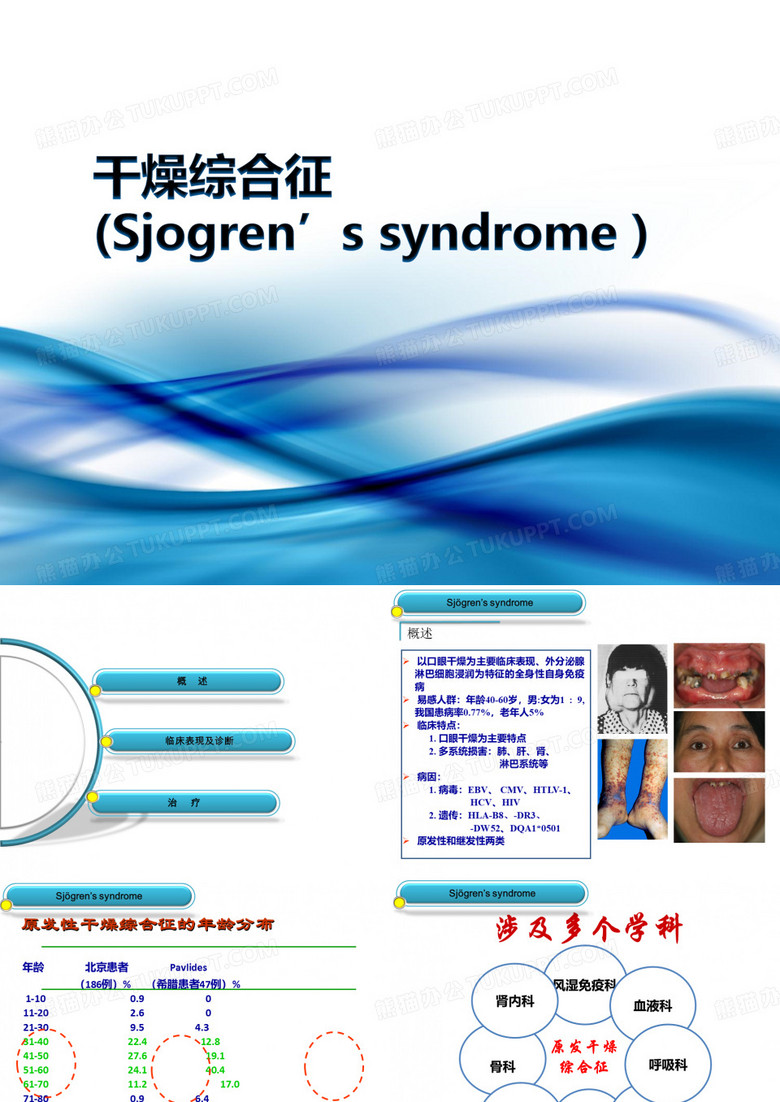 干燥综合征