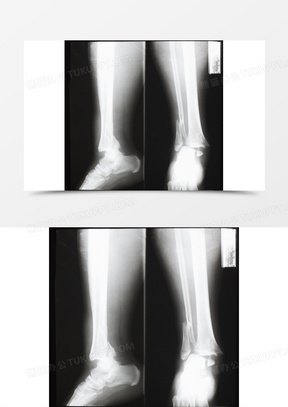 正常人的小腿x光照图片