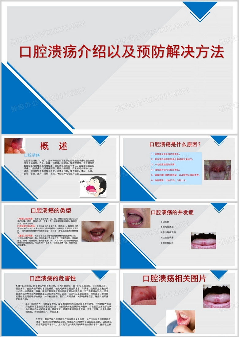口腔溃疡的介绍以及预防改善方法
