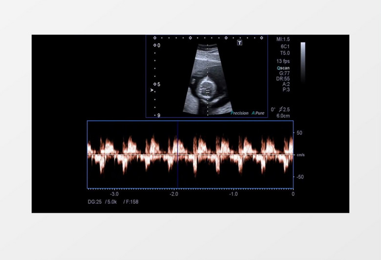 多普勒彩超监测胎动实拍视频素材