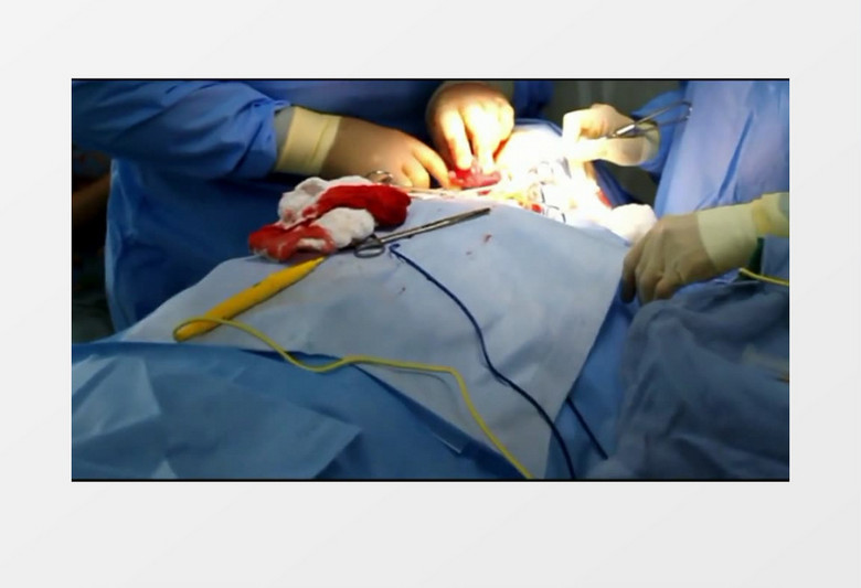 健康专业外科医生手术实拍视频素材
