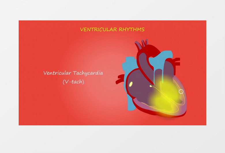 医学心脏结构心律失常视频素材